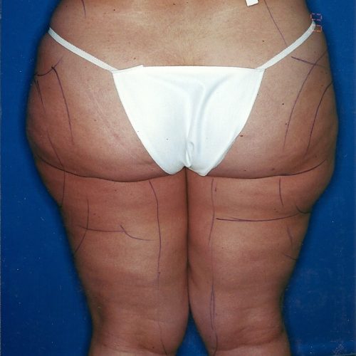 Liposuction before and after - before