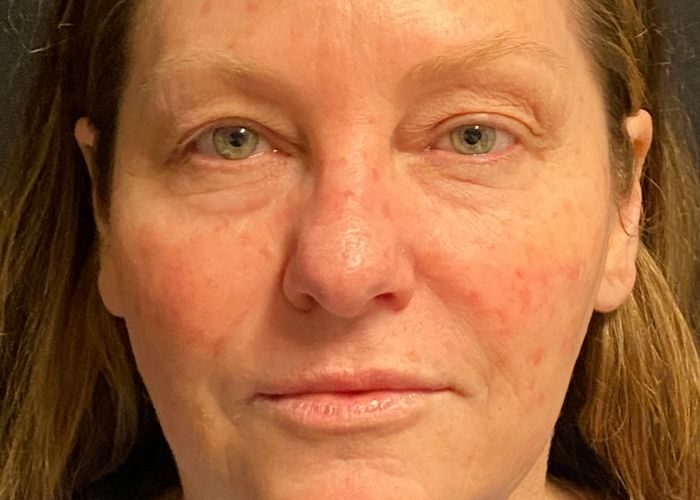 Eyelid Surgery before — Dr. Ronald Edelson