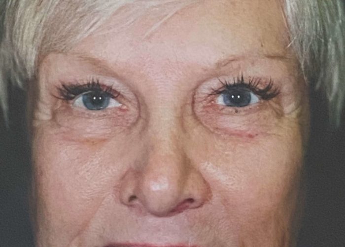 Eyelid Surgery before — Dr. Ronald Edelson