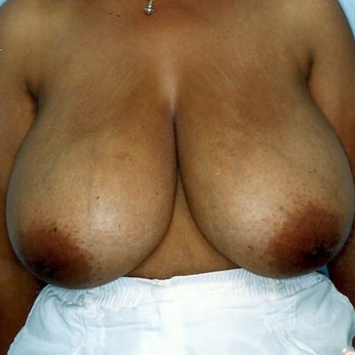 Breast Reduction before and after - before