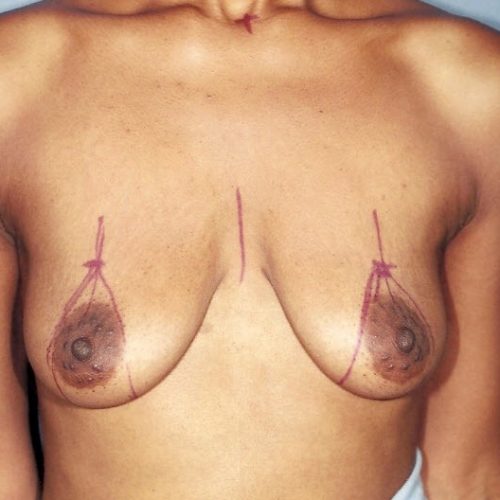 Breast Lift before and after - before