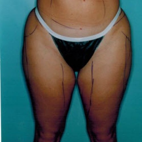 Liposuction before and after - before