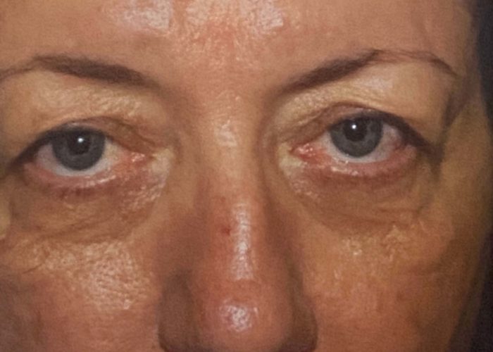 Eyelid Surgery before — Dr. Ronald Edelson