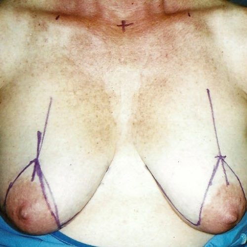 Breast Lift before and after - before