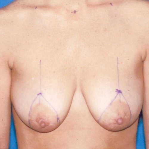 Breast Lift before and after - before