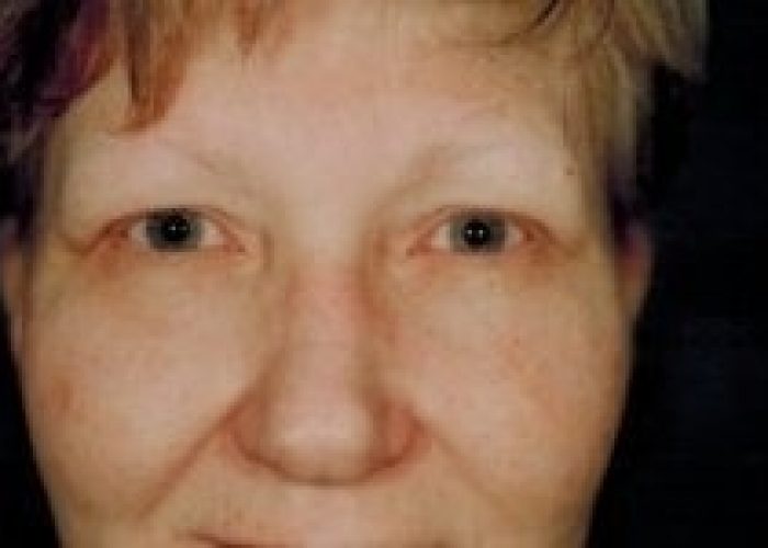 Eyelid Surgery before — Dr. Ronald Edelson
