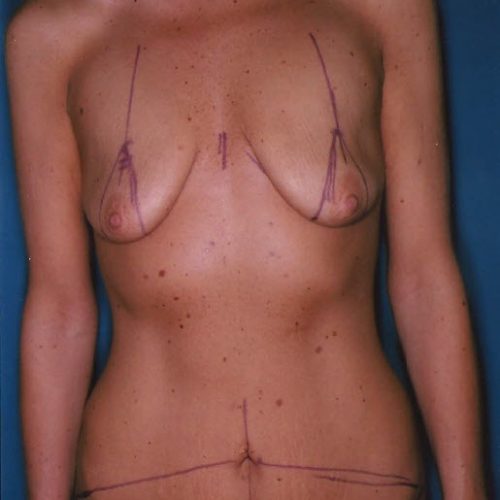 Breast Lift before and after - before