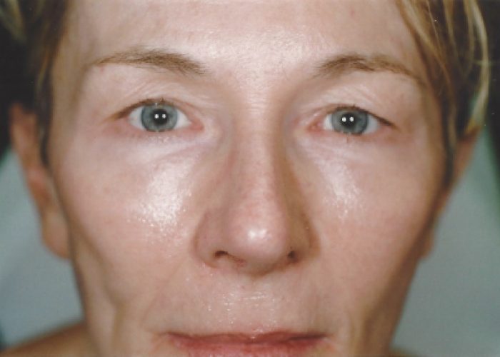Eyelid Surgery before — Dr. Ronald Edelson