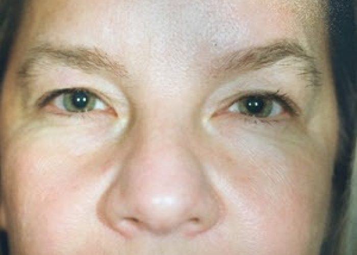 Rhinoplasty before and after - before