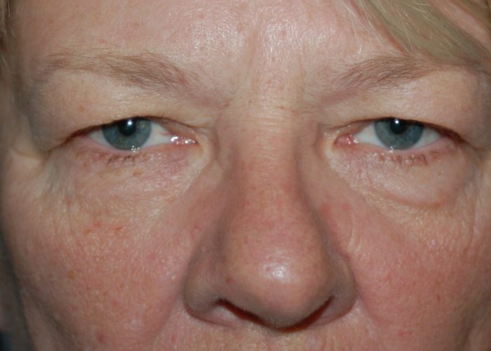 Eyelid Surgery before — Dr. Ronald Edelson
