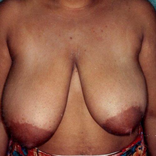 Breast Reduction before and after - before