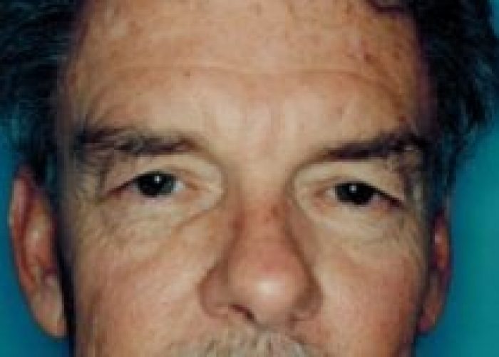Eyelid Surgery before — Dr. Ronald Edelson