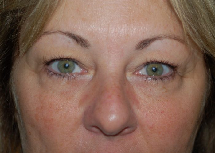 Eyelid Surgery before — Dr. Ronald Edelson