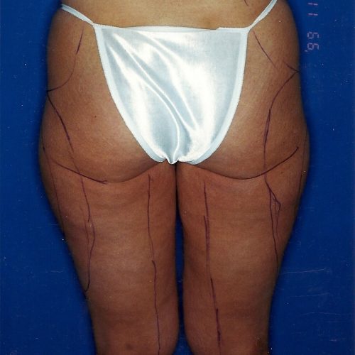 Liposuction before and after - before