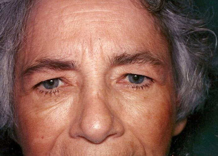Eyelid Surgery before — Dr. Ronald Edelson