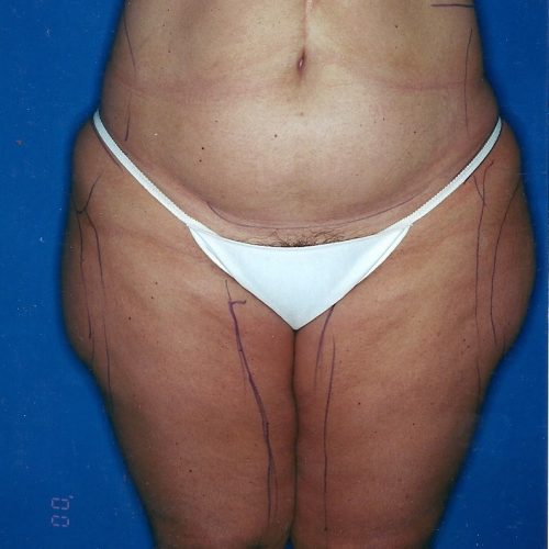 Liposuction before and after - before