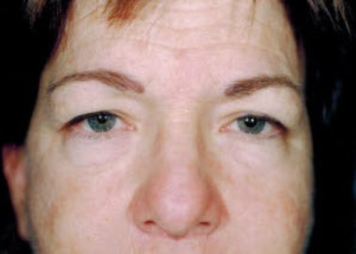 Eyelid Surgery before — Dr. Ronald Edelson