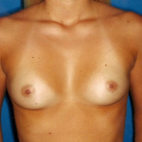 Breast Augmentation before and after - before