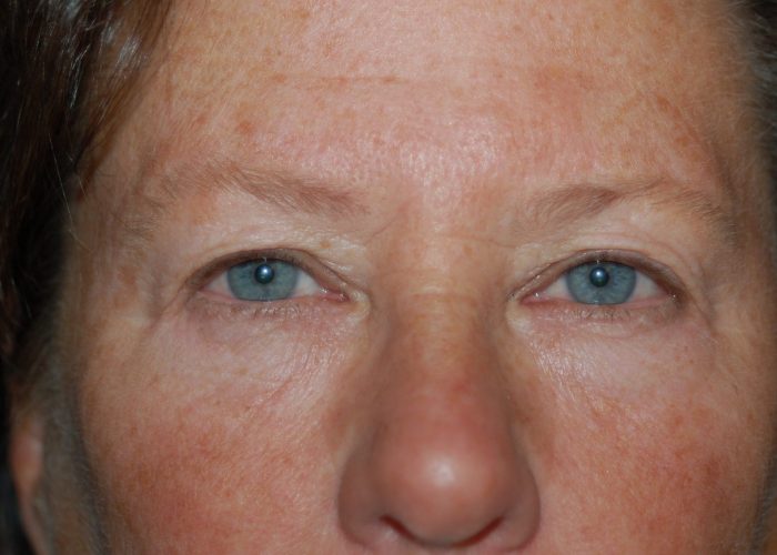 Eyelid Surgery before — Dr. Ronald Edelson