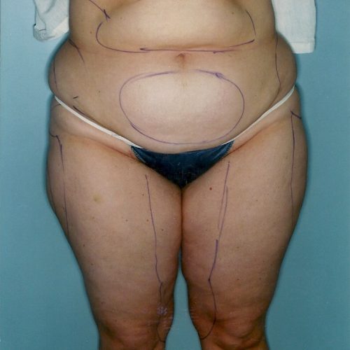 Liposuction before and after - before