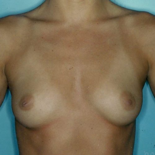 Breast Augmentation before and after - before