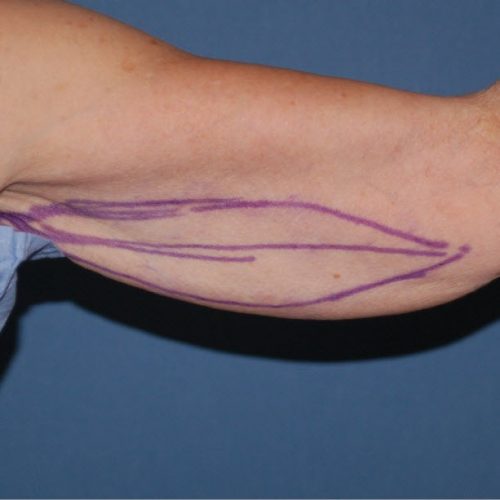 Arm Lift before and after - before