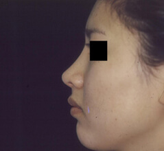Rhinoplasty before and after - after