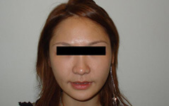 Procedure before and after - after