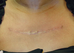 Procedure before and after - after