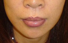 Procedure before and after - after