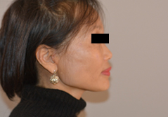 Facelift before and after - after