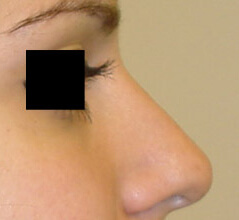 Rhinoplasty before and after - after