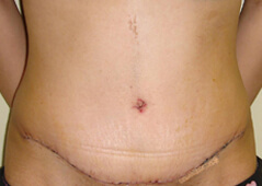 Mommy Makeover before and after - after