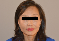 Facelift before and after - after