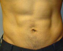 Liposuction before and after - after