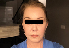 Procedure before and after - after