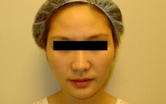 Procedure before and after - before
