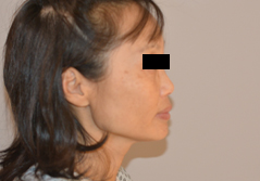 Facelift before and after - before