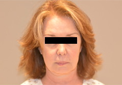 Procedure before and after - before
