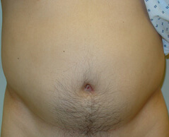 Liposuction before and after - before