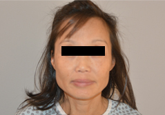 Facelift before and after - before
