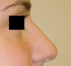 Rhinoplasty before and after - before