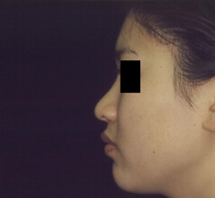 Rhinoplasty before and after - before