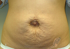 Procedure before and after - before