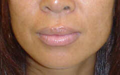 Procedure before and after - before