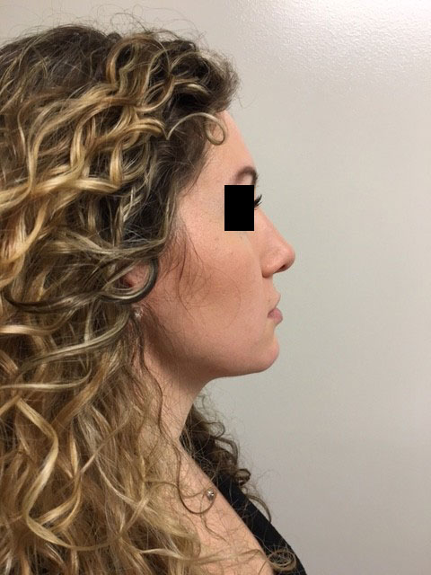 Rhinoplasty before and after - before
