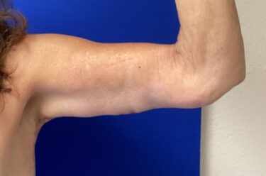 Arm Lift before and after - after