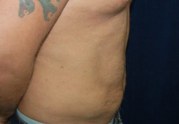Liposuction before and after - after