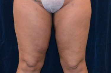 Liposuction before and after - after