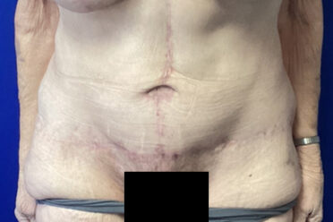Abdominoplasty before and after - after